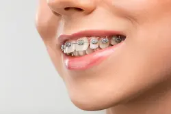 The start of the admission to the International Orthodontic Program at Future University in Egypt 